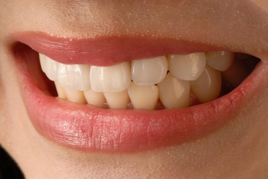 Veneers in Dubai